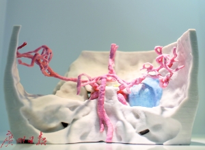 邁普再生醫(yī)學(xué)展示的3D打印顱頸交界腫瘤模型。
